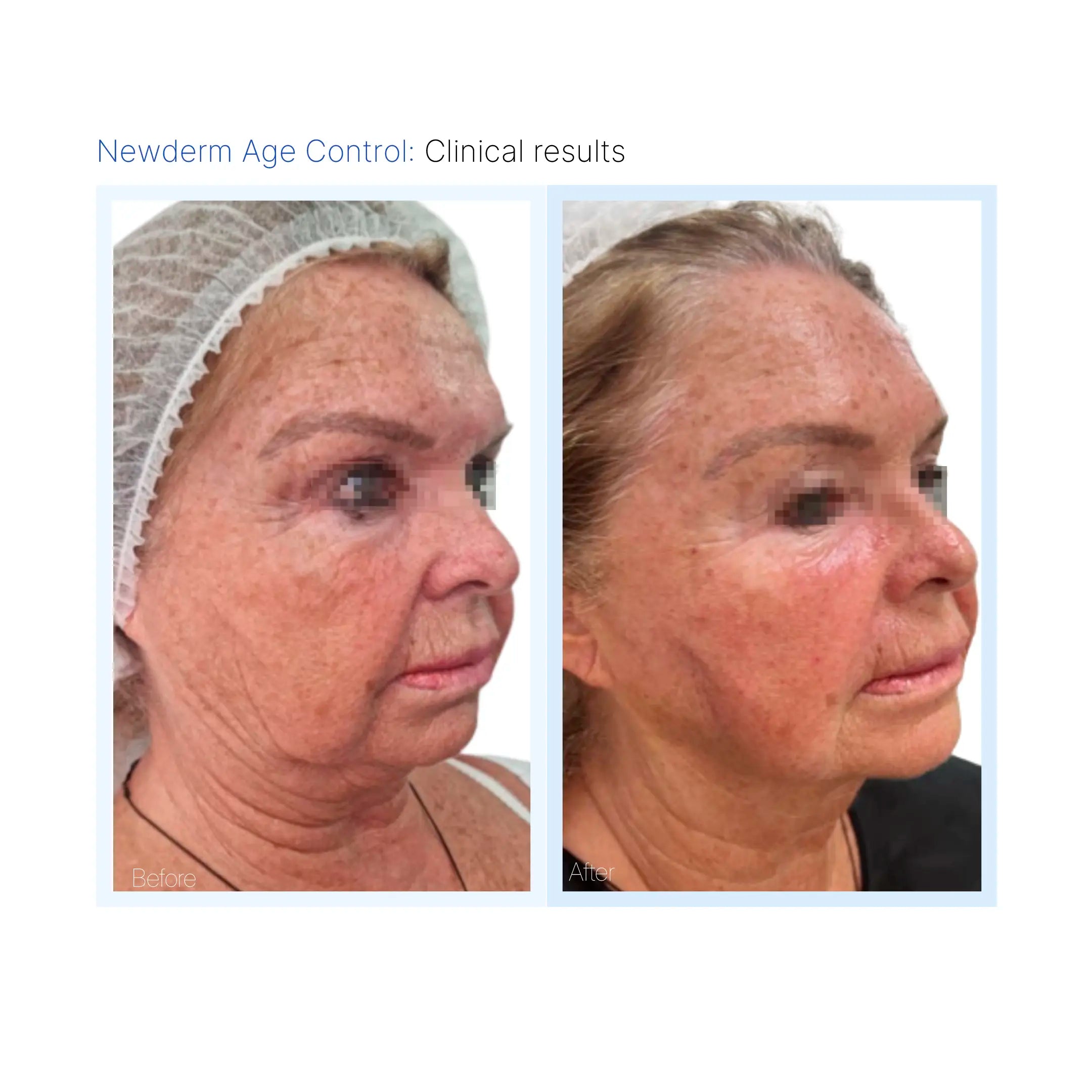 Newderm Age Control