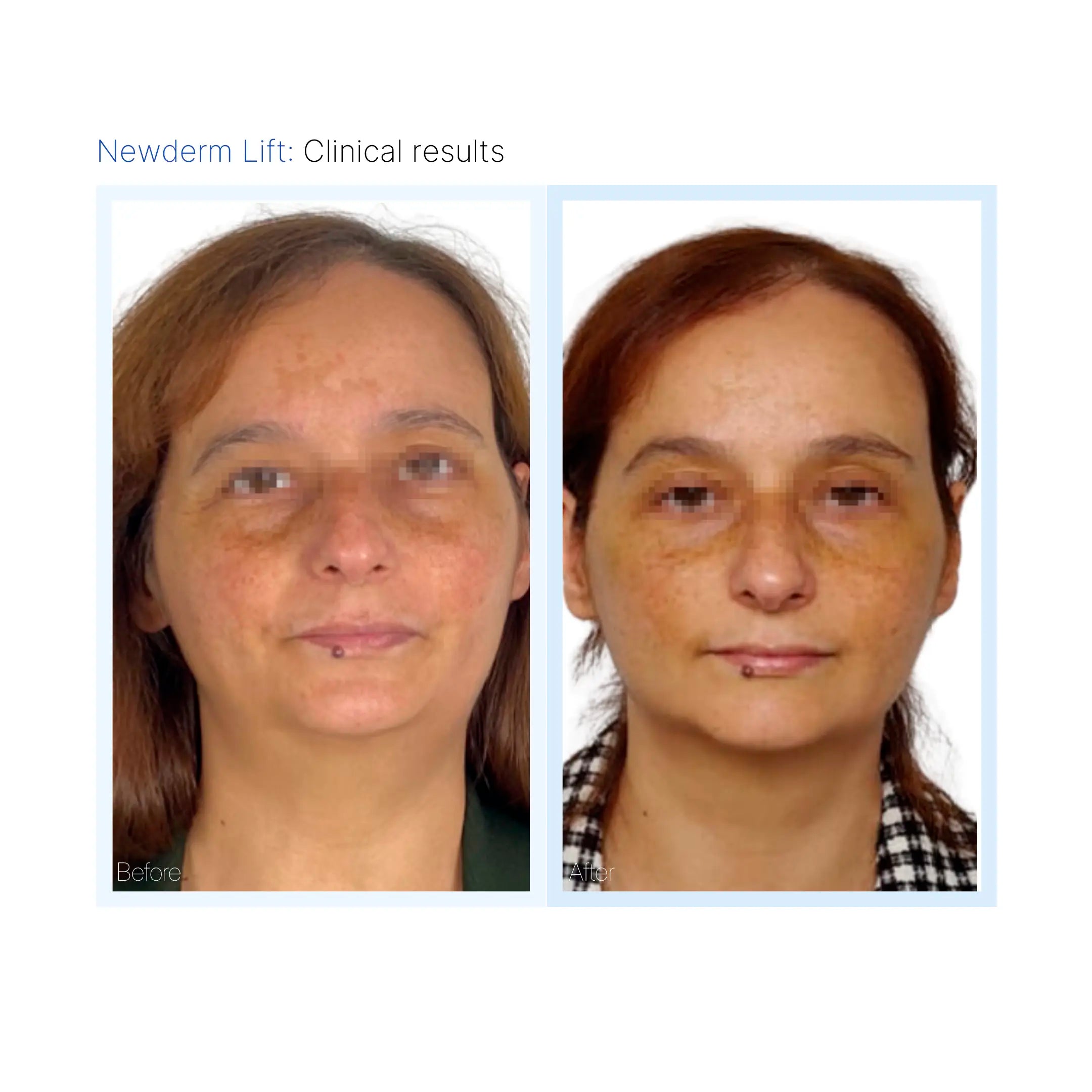 Newderm Lift