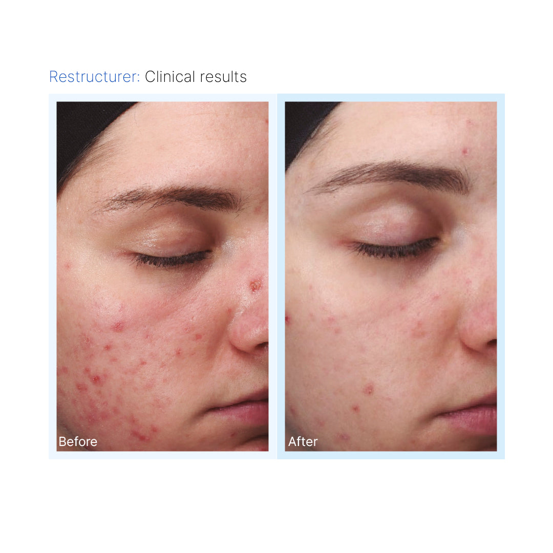 Blemiderm® Pack