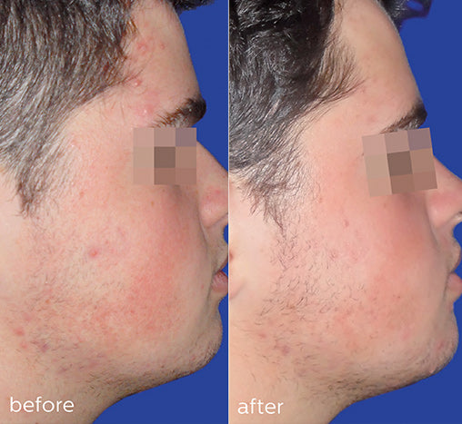 Pure Renewing Mask