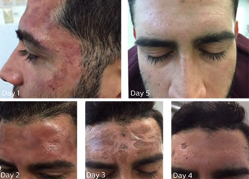 Skin Recovery