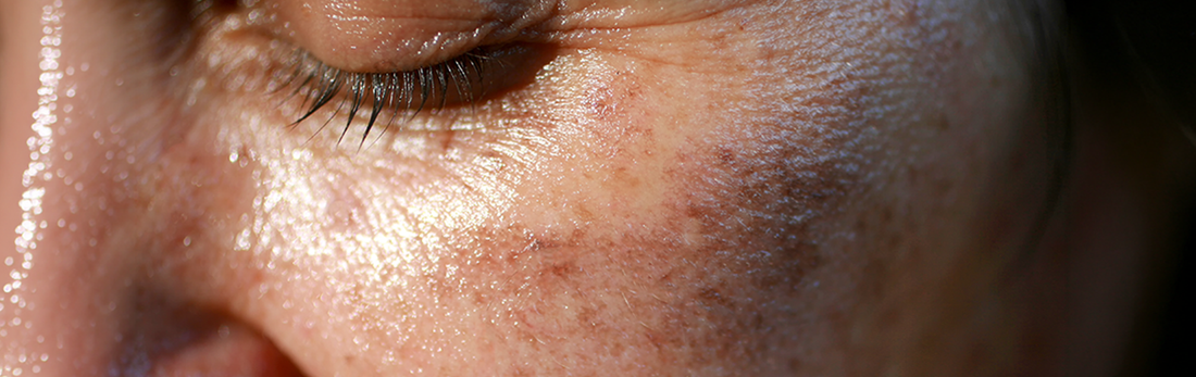 Why Stubborn Pigmentation Is Not a Problem — It's an Unfinished Protocol