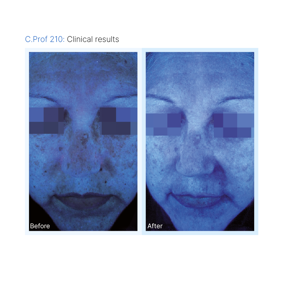 C.PROF 210 Depigmentation Solution