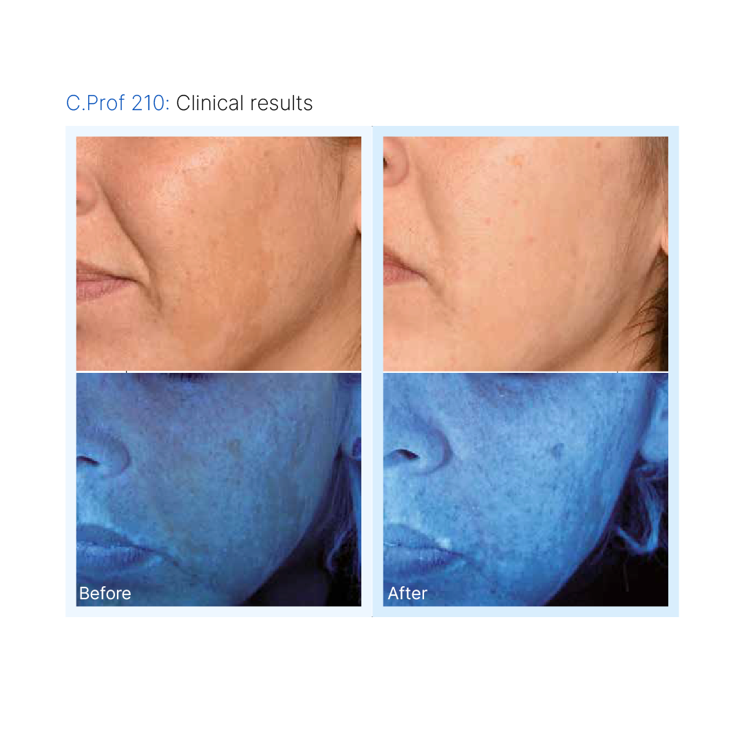 C.PROF 210 Depigmentation Solution