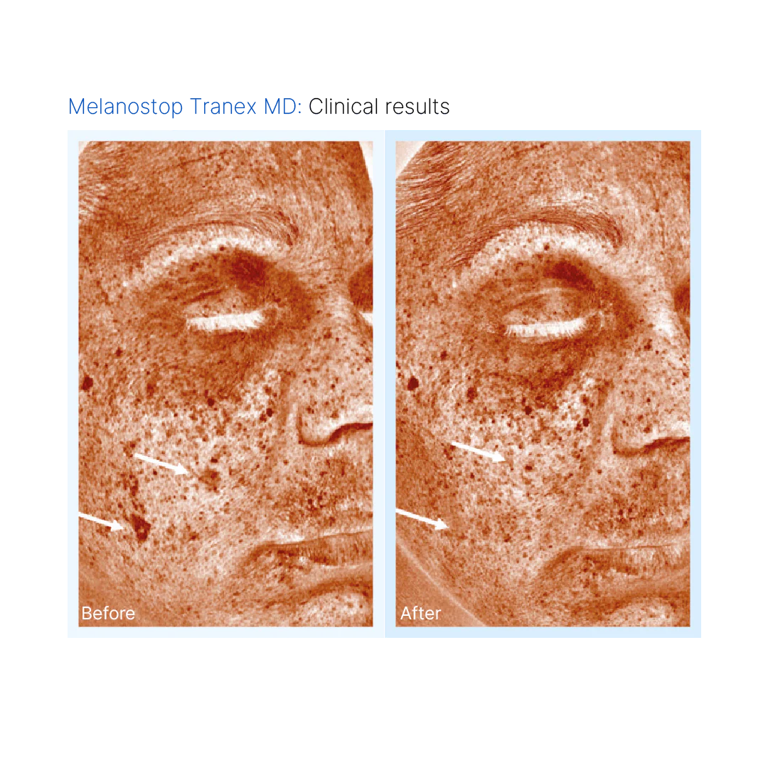 Mesopeel® Melanostop Tranex