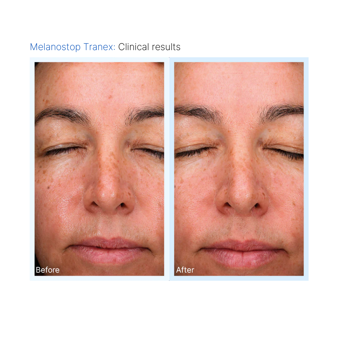Mesopeel® Melanostop Tranex