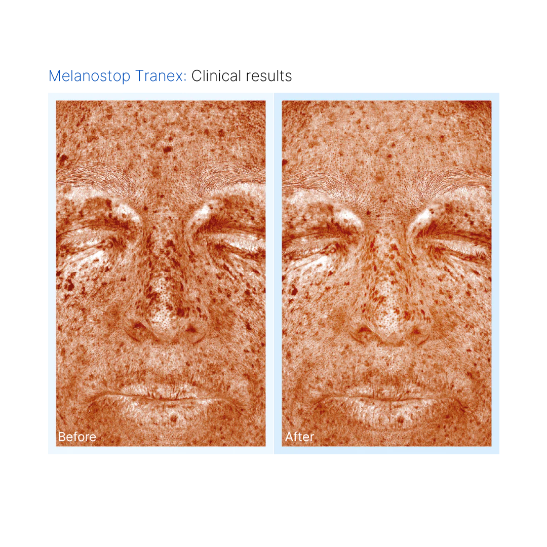 Mesopeel® Melanostop Tranex