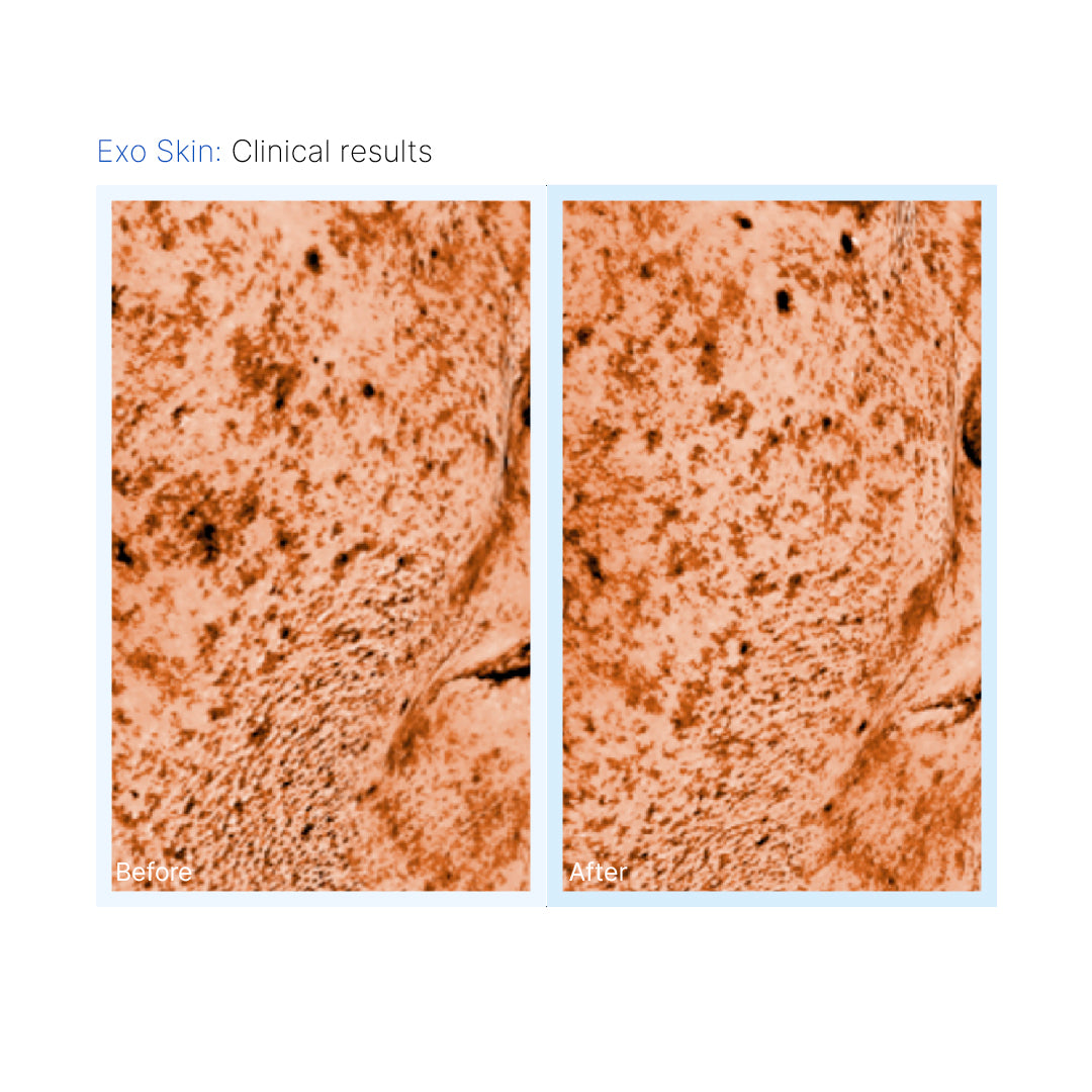 INNO EXOMA® EXO-SKIN