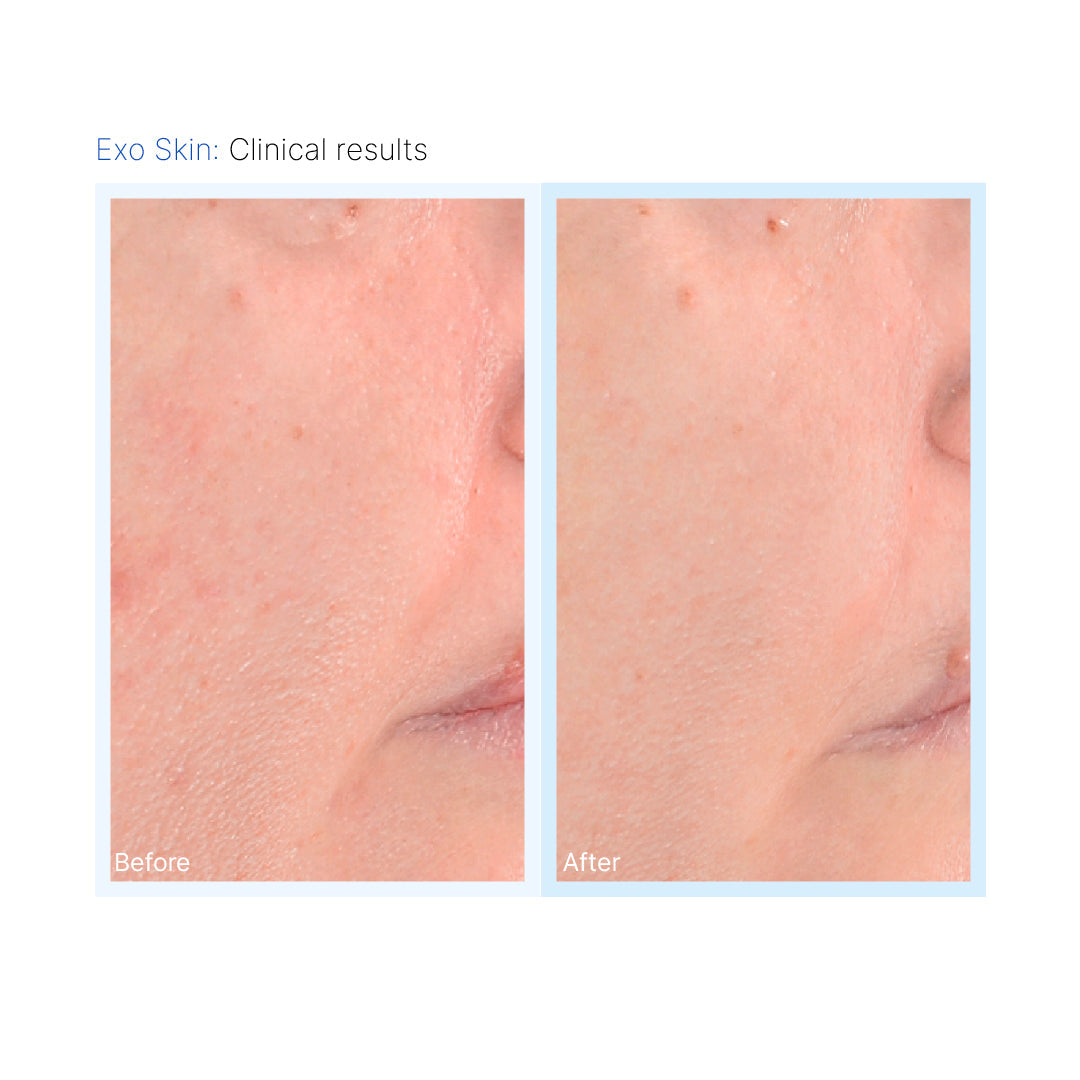 INNO EXOMA® EXO-SKIN