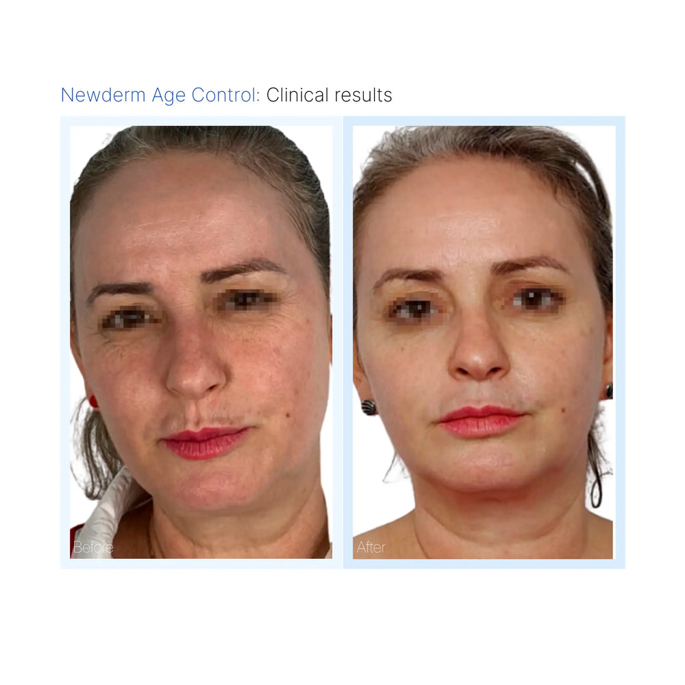 Newderm Age Control