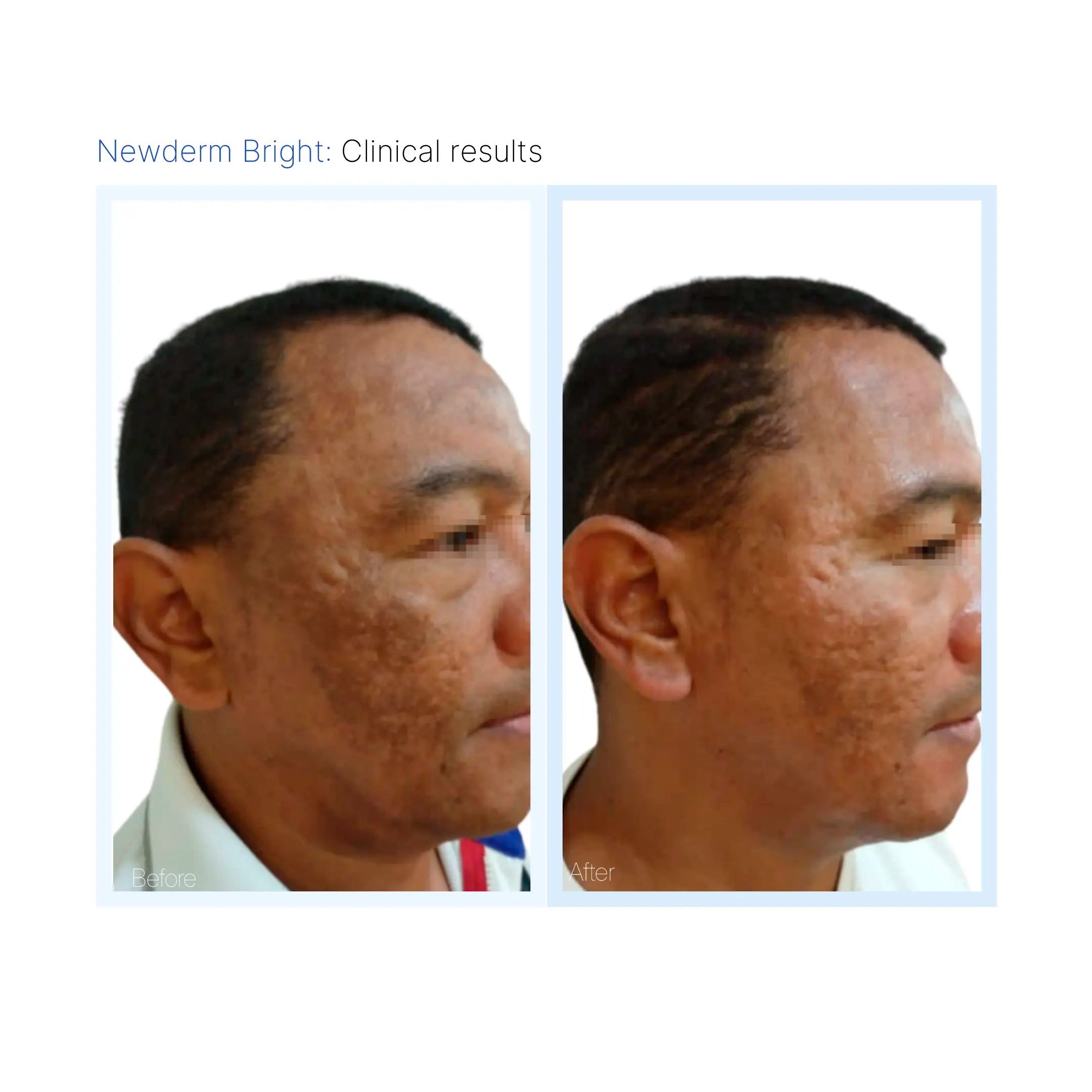 Newderm Bright