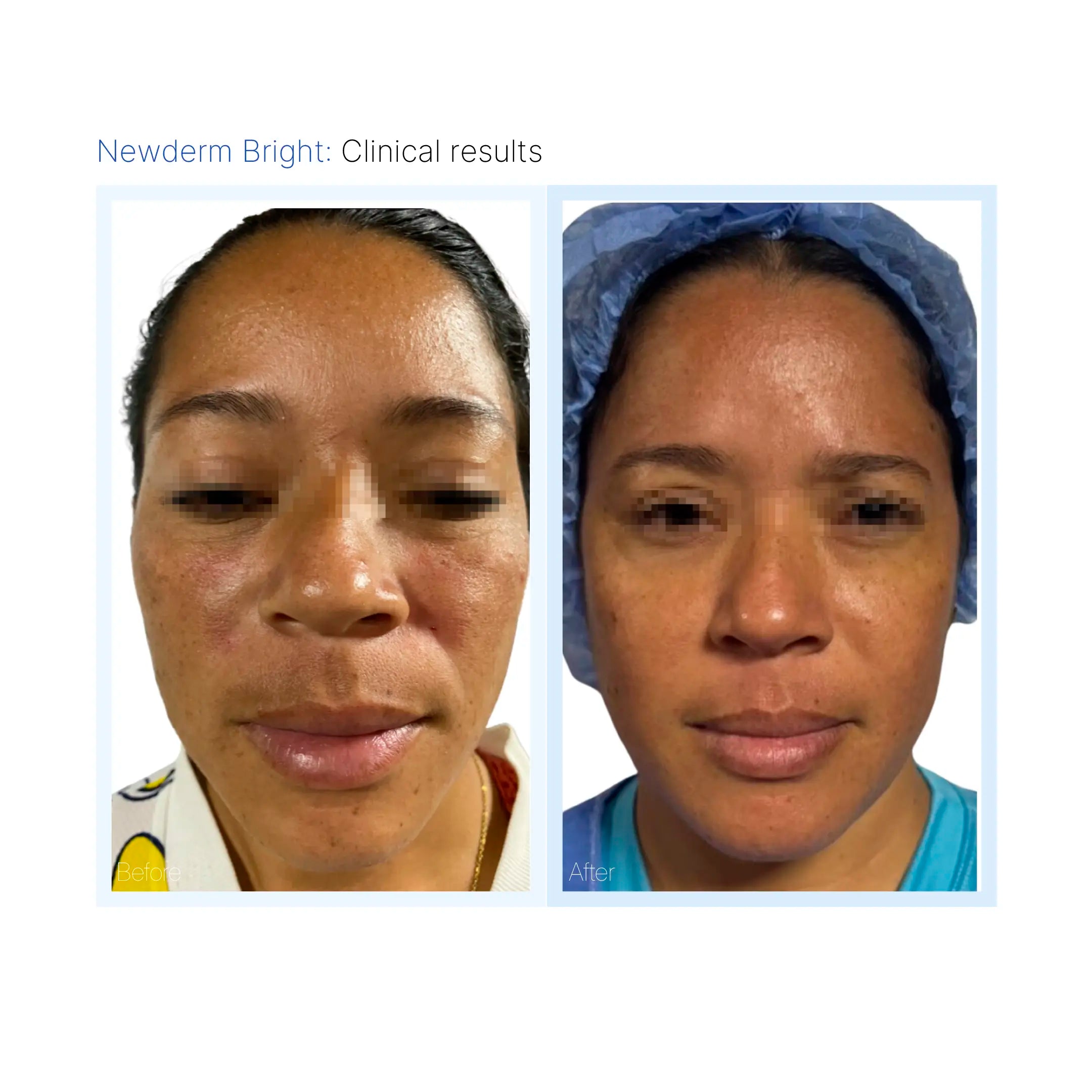 Newderm Bright