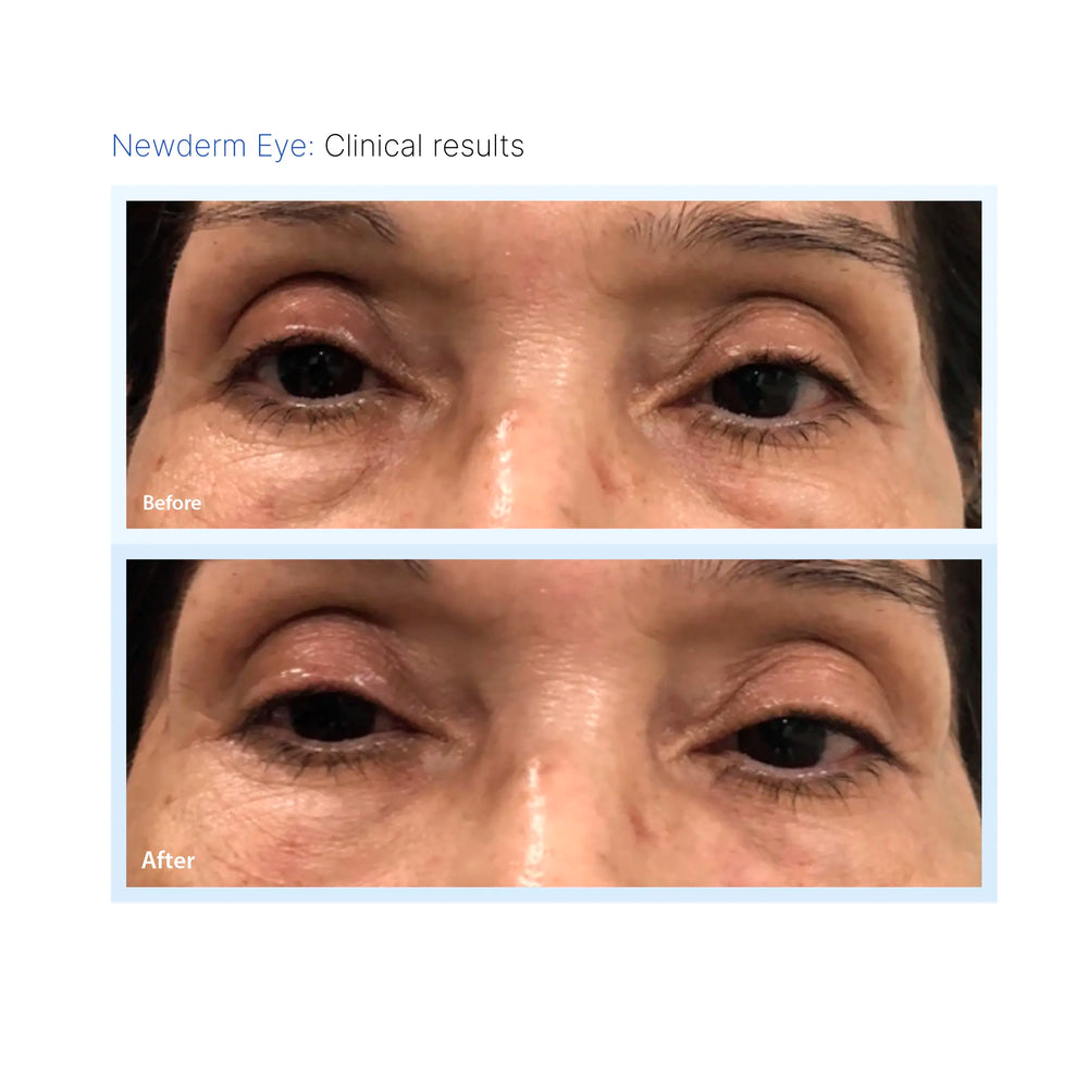 Newderm Eye
