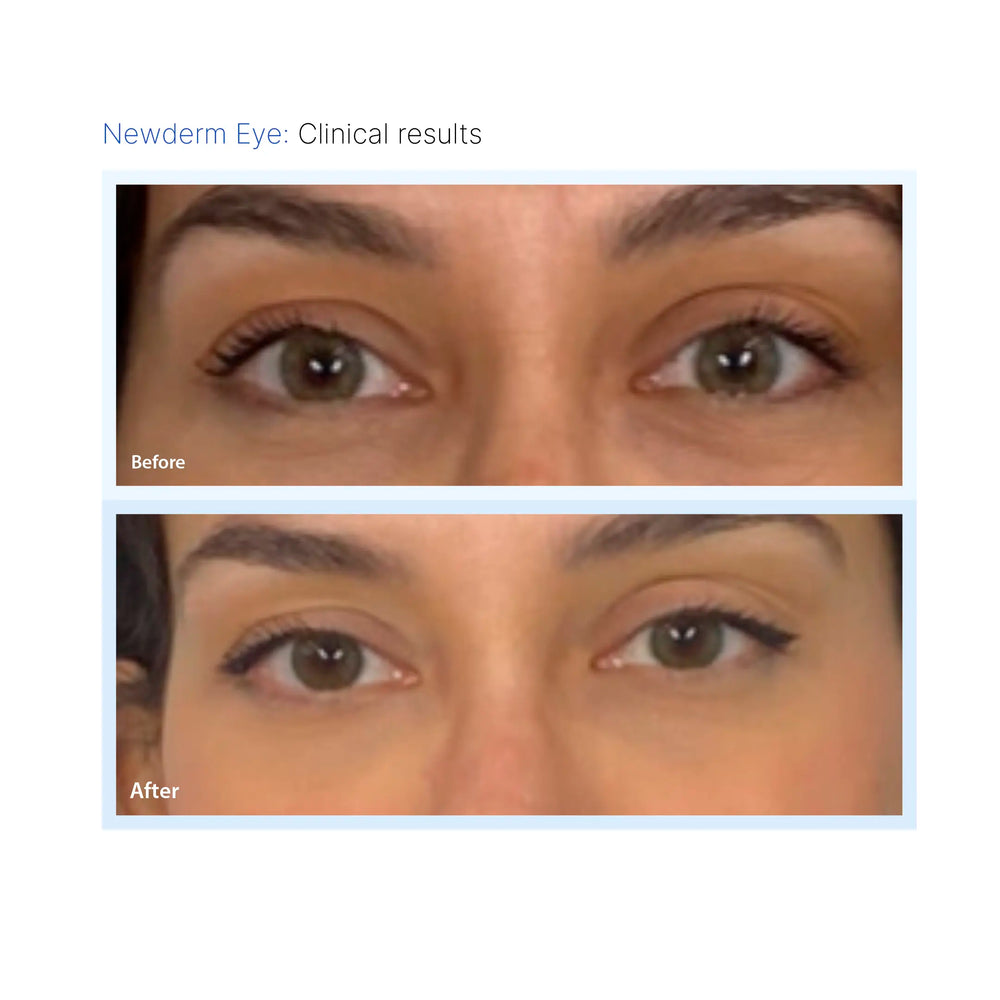Newderm Eye