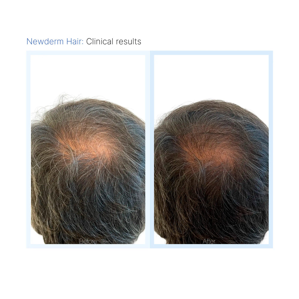 Newderm Hair