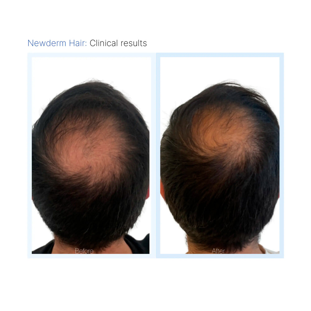 Newderm Hair