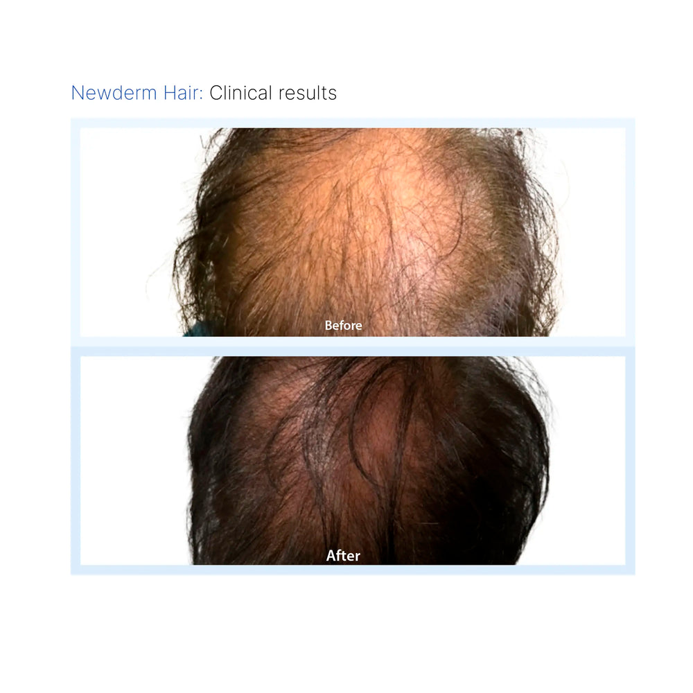 Newderm Hair