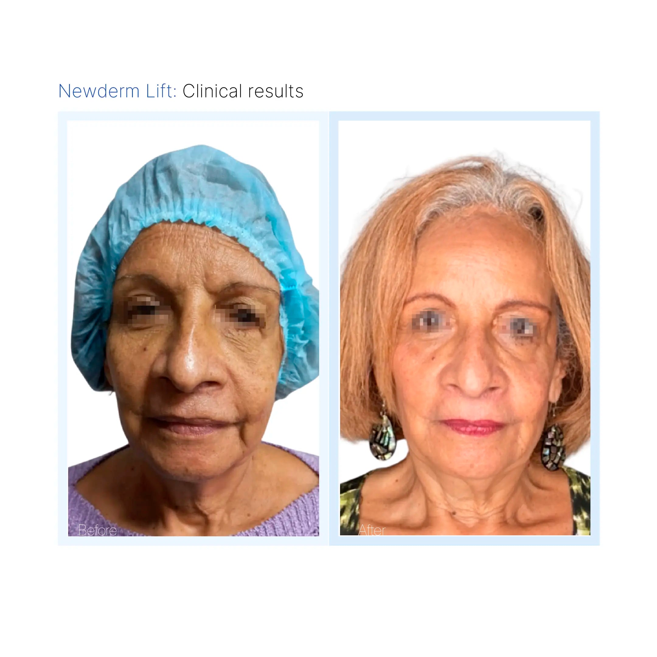 Newderm Lift
