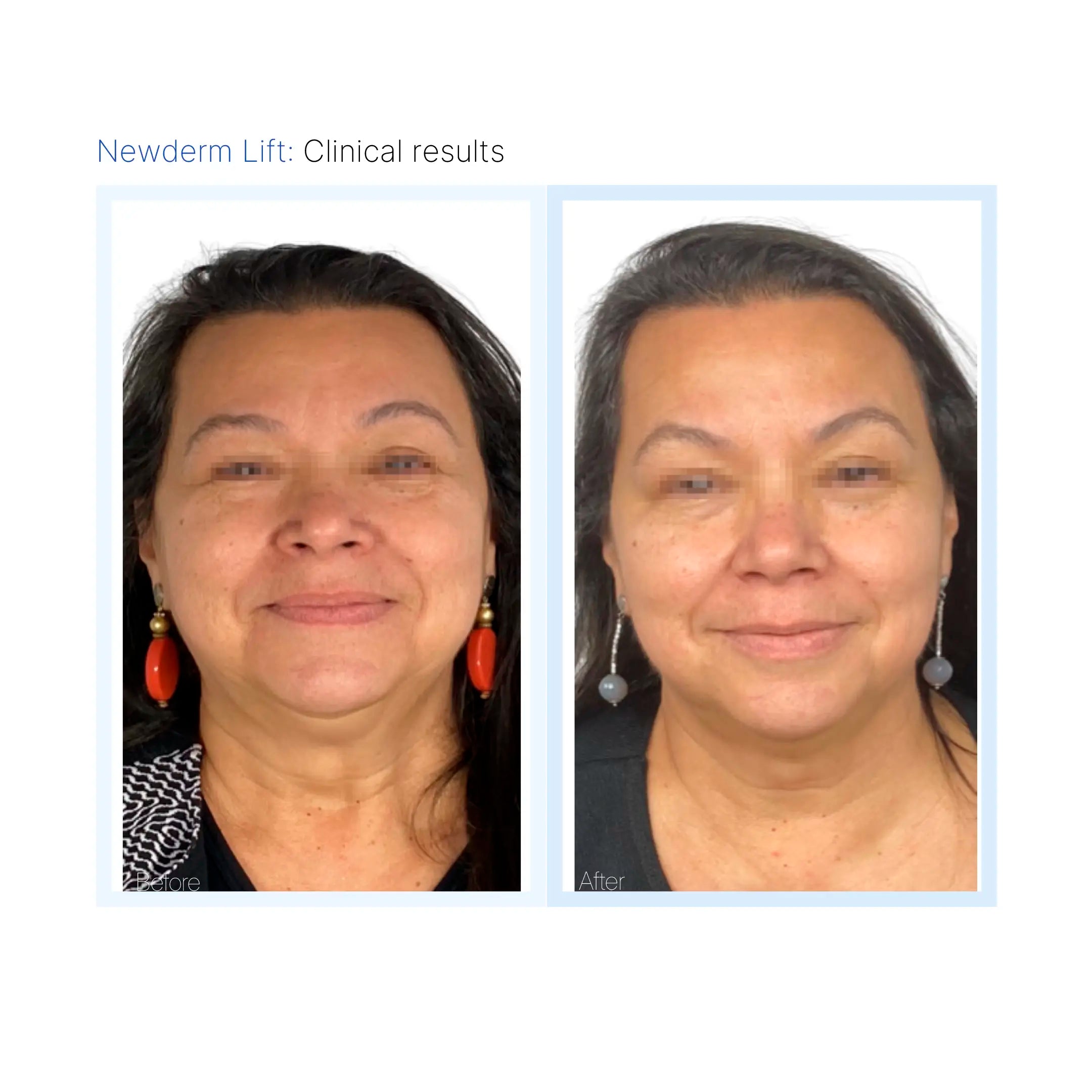 Newderm Lift