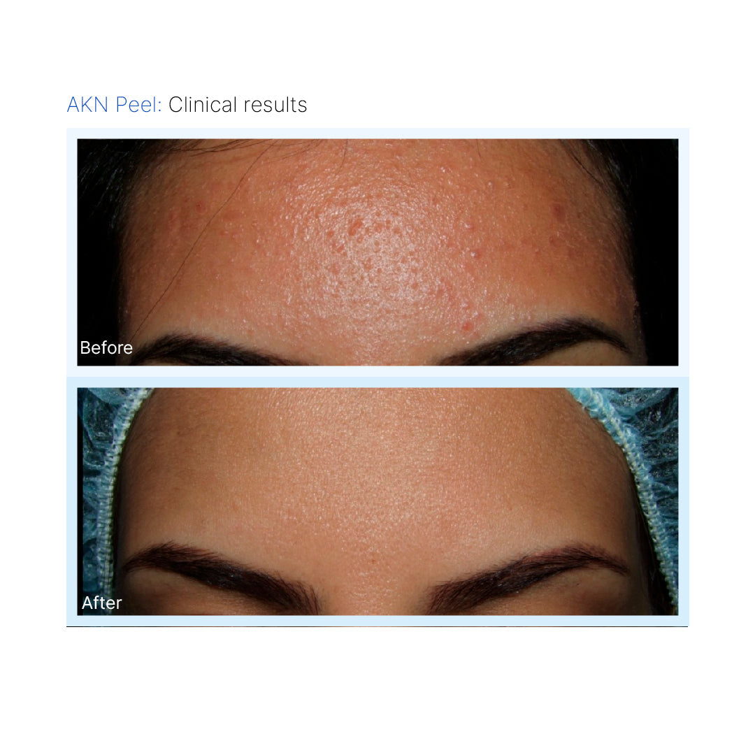 AKN Peel