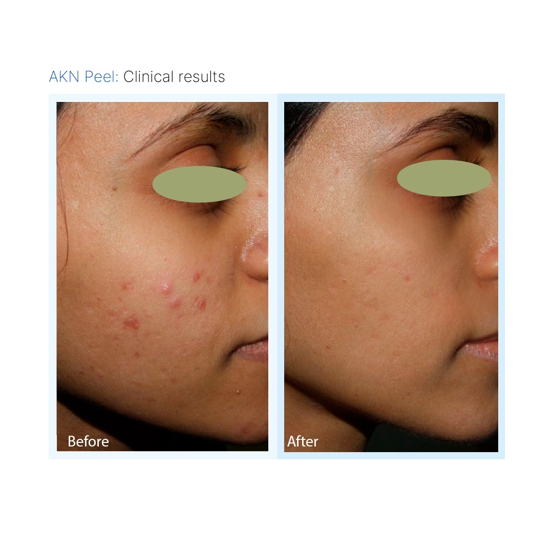 AKN Peel