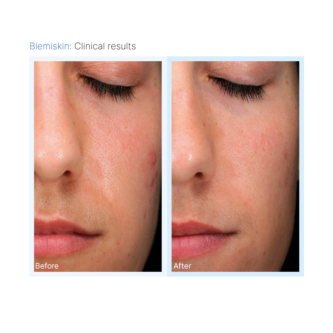 Mesopeel® Blemiskin