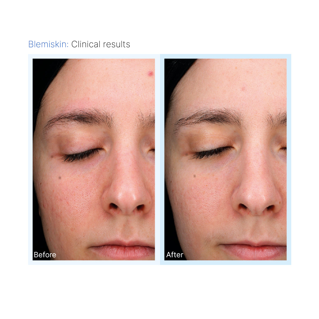 Mesopeel® Blemiskin