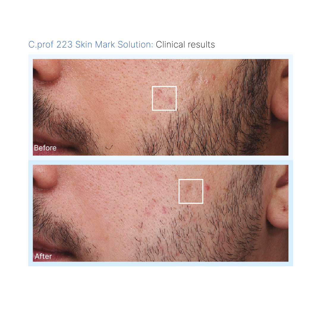 C.PROF 223 Skinmark Solution