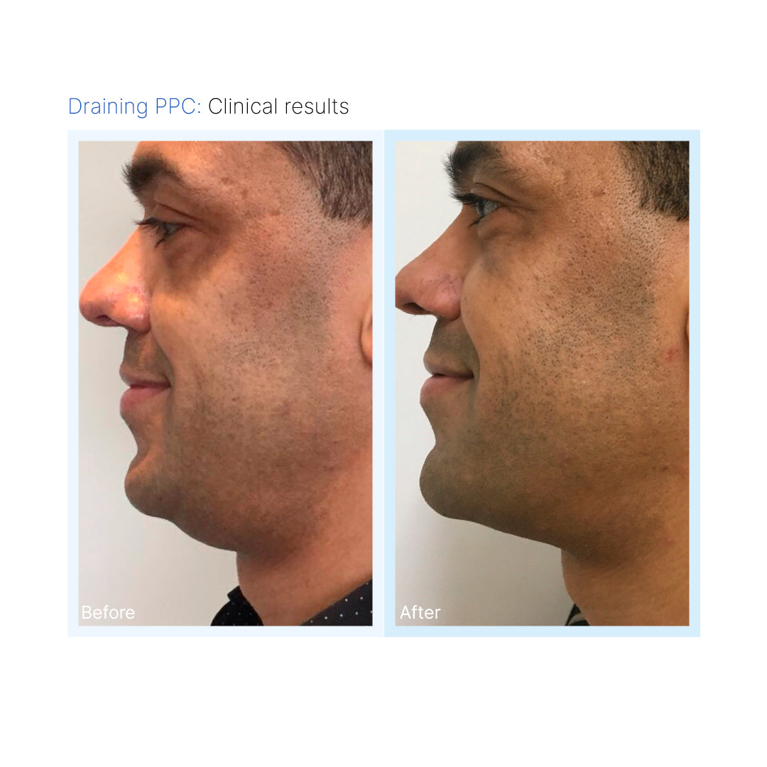 Draining PPC