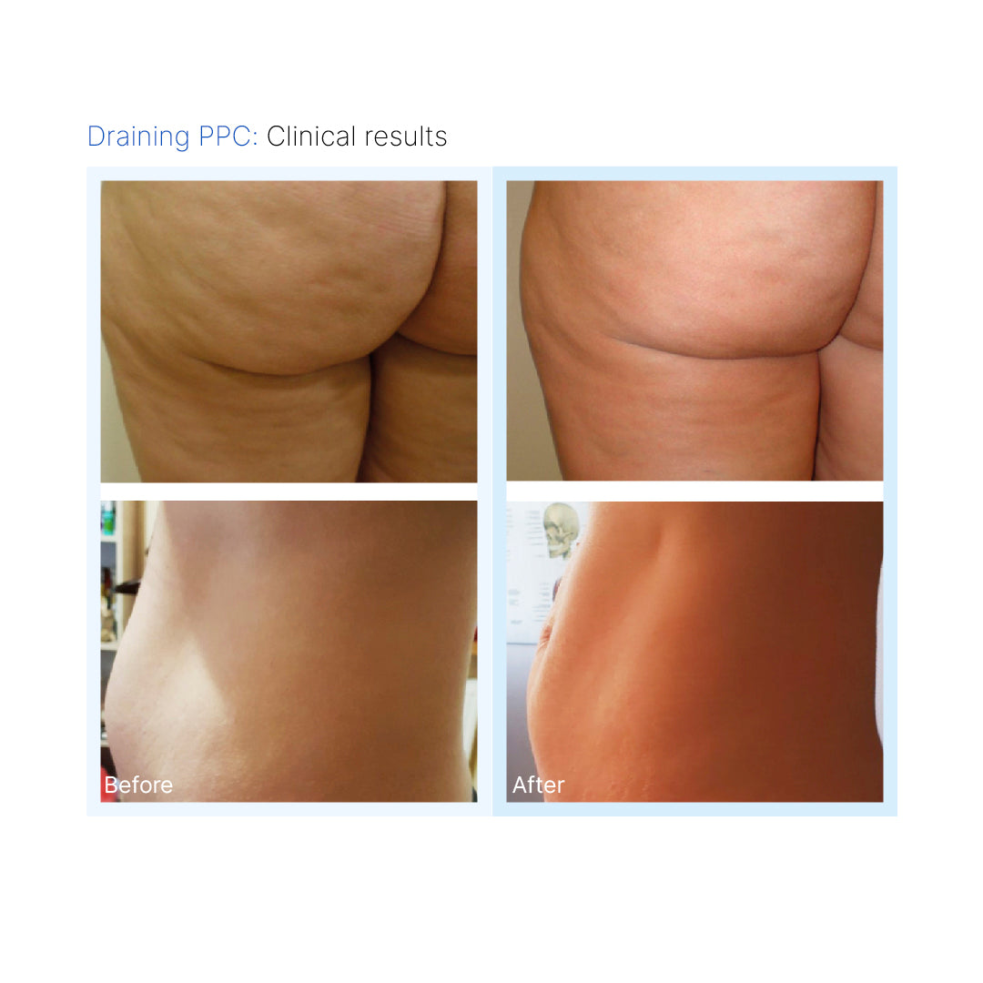 Draining PPC