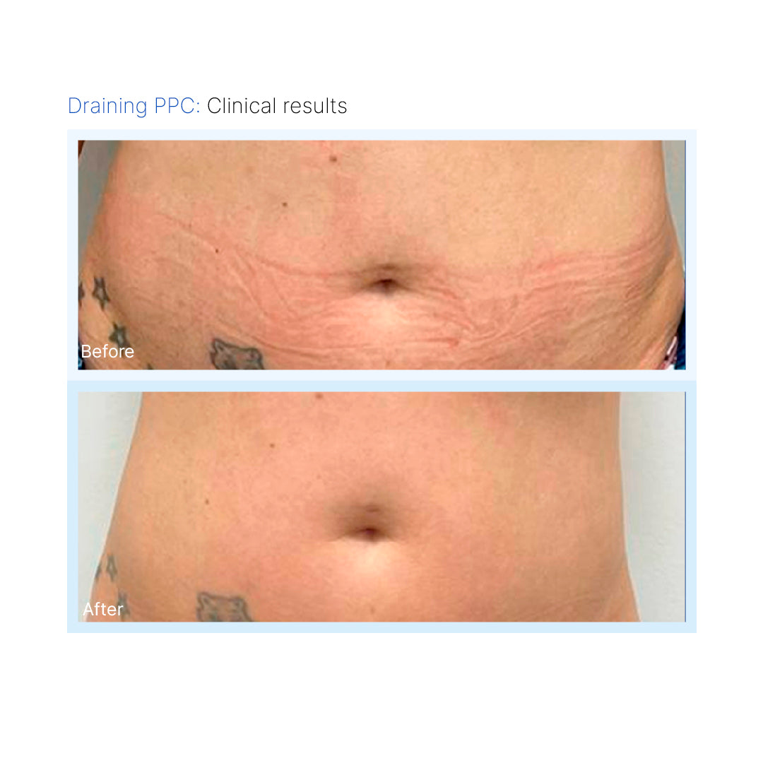 Draining PPC