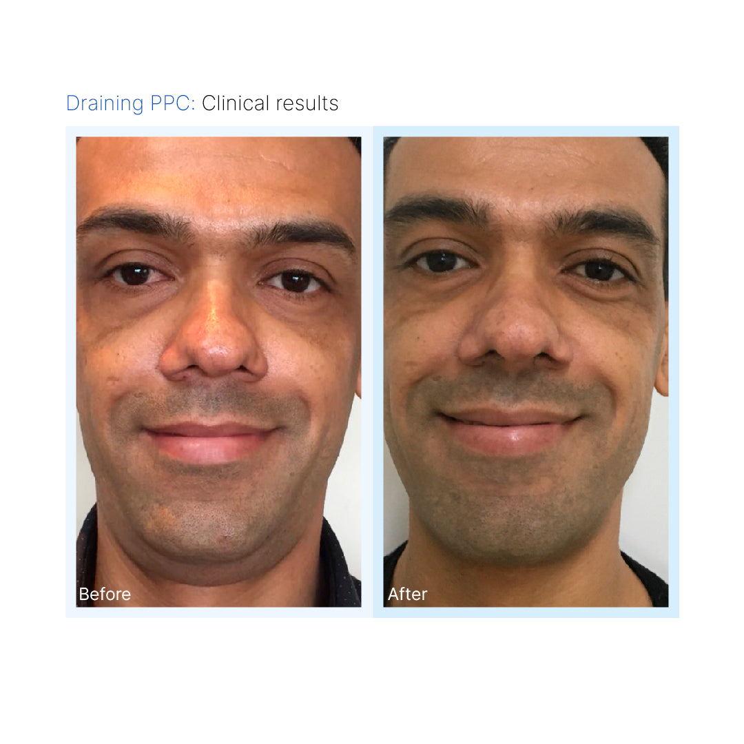 Draining PPC
