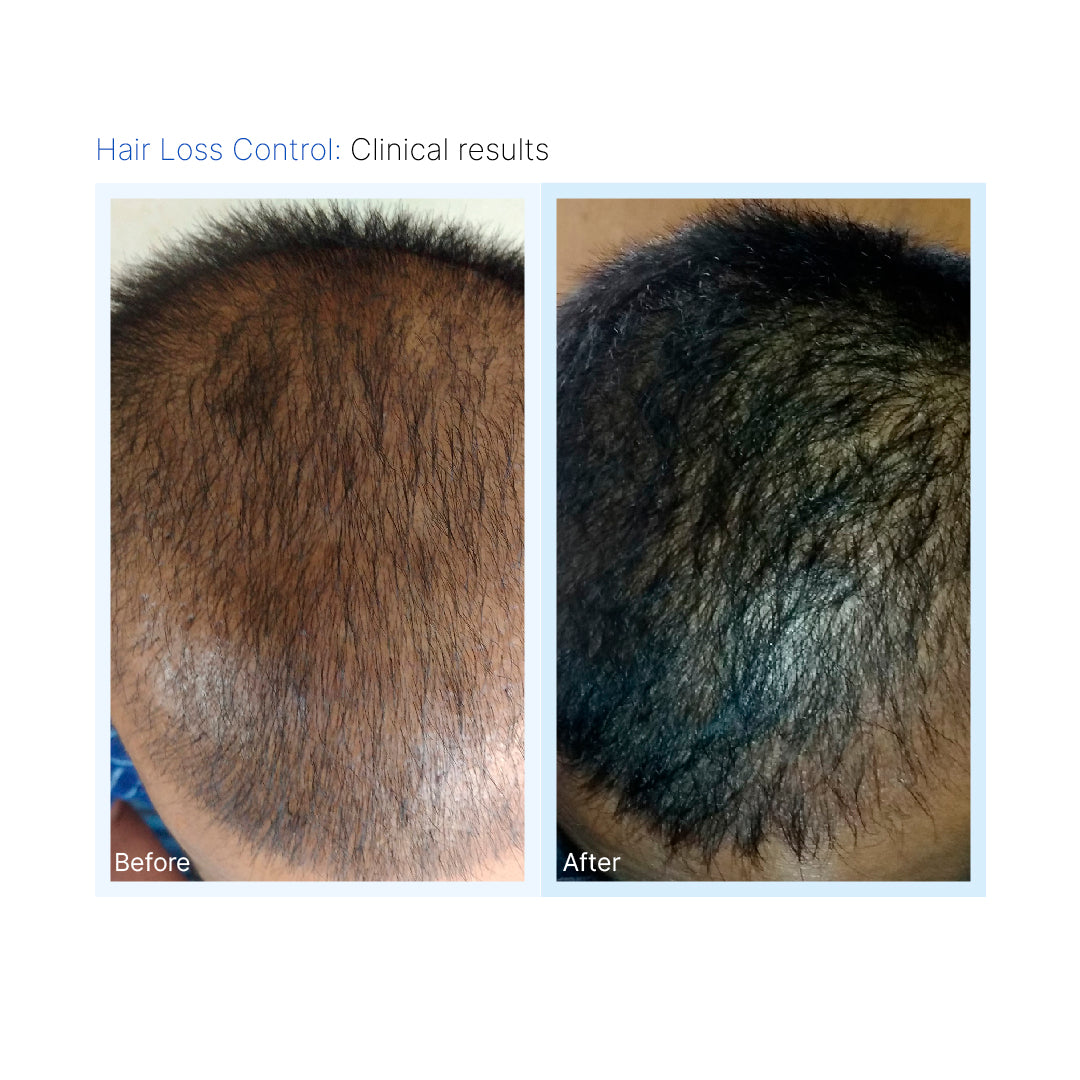 Hair Loss Control