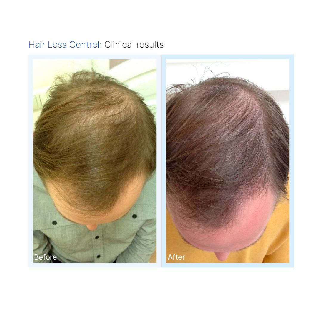 Hair Loss Control
