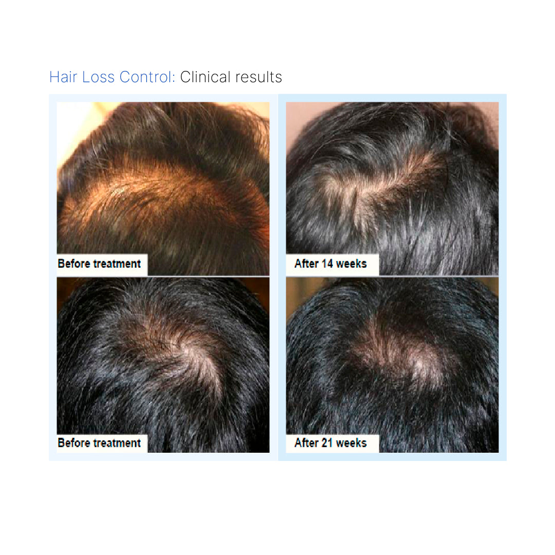 Hair Loss Control