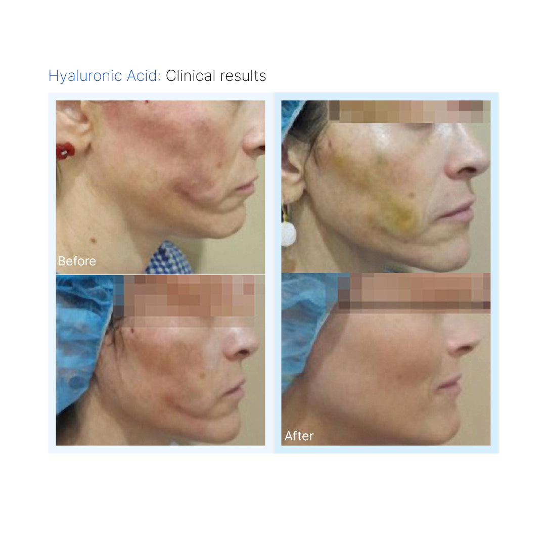 Hyaluronic Acid TDS