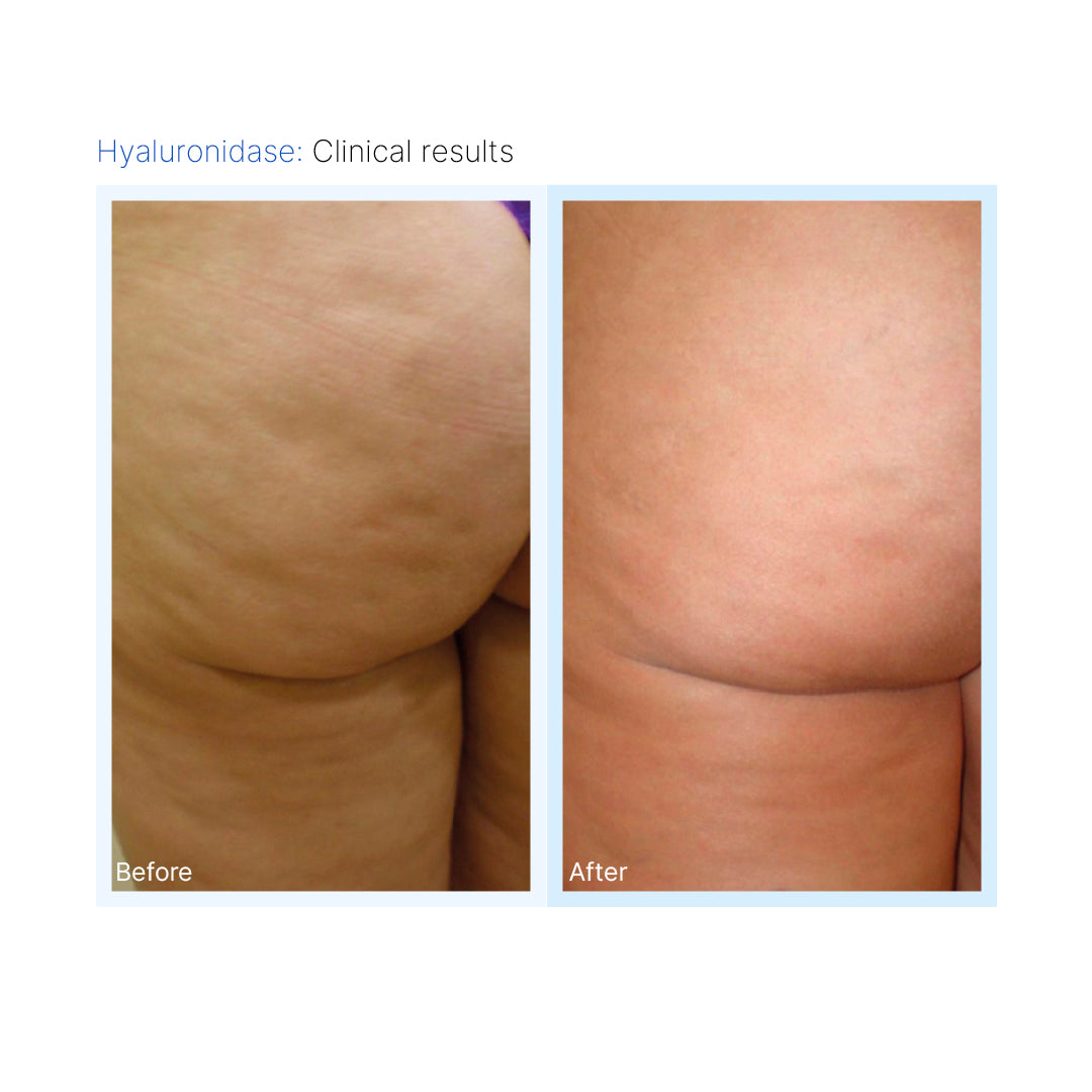 Hyaluronidase