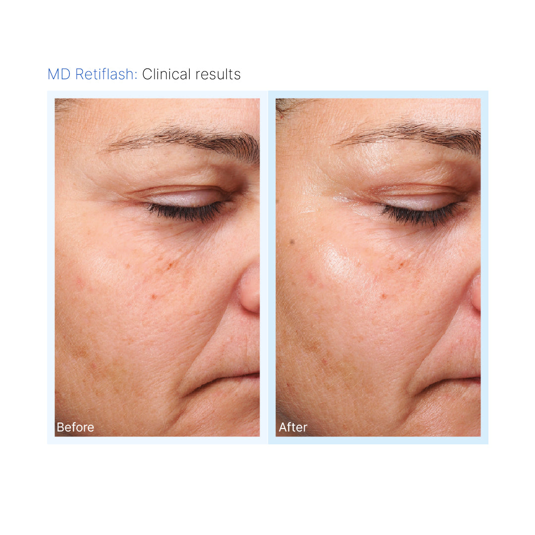 Mesopeel® MD Retiflash