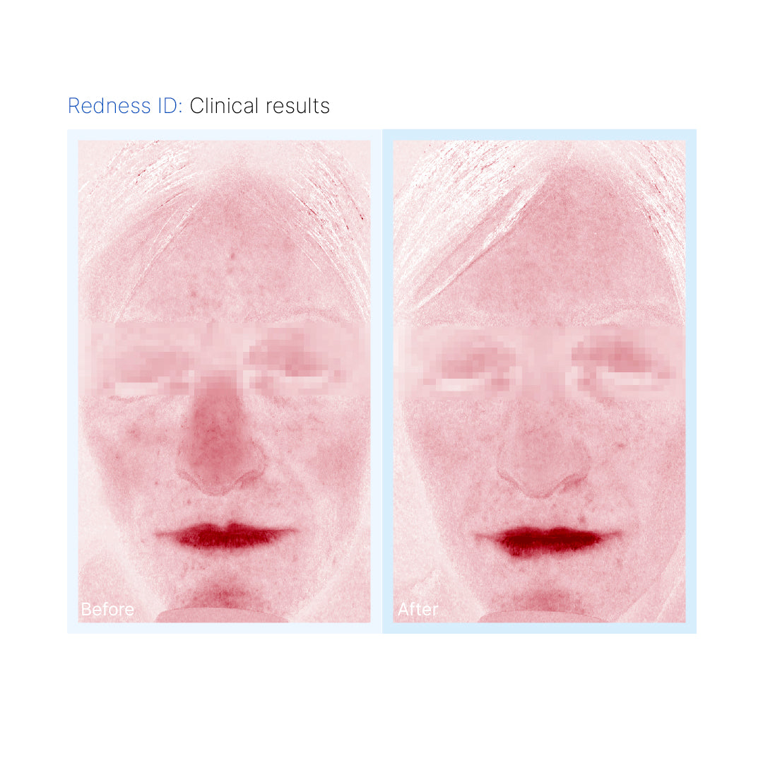 Redness ID