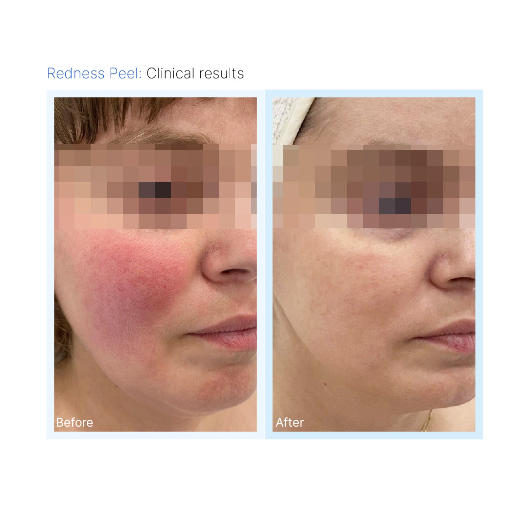 Redness Peel