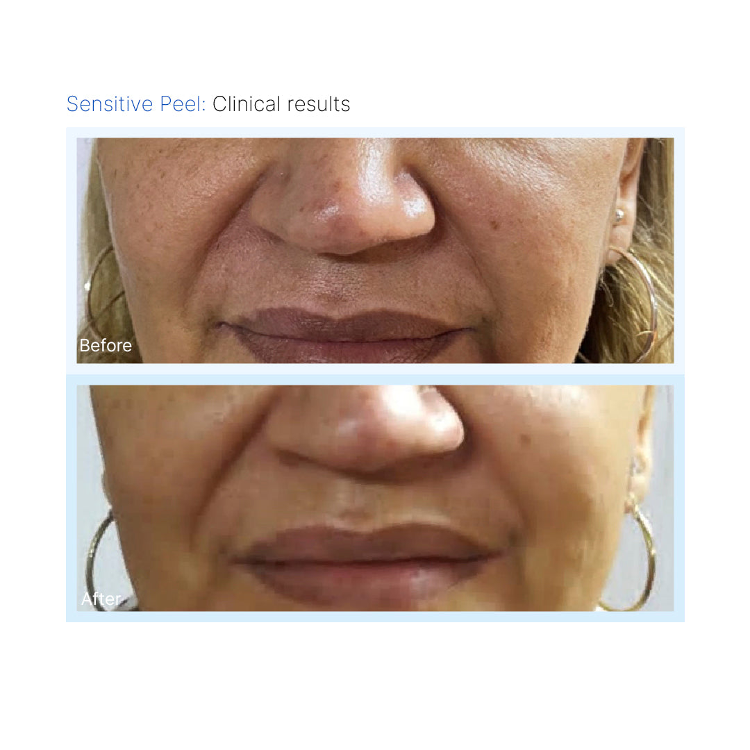 Sensitive Peel