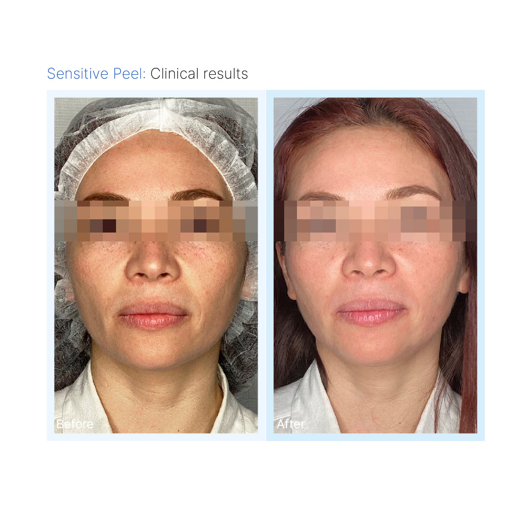 Sensitive Peel