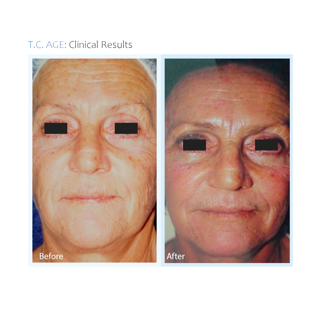 TC Age