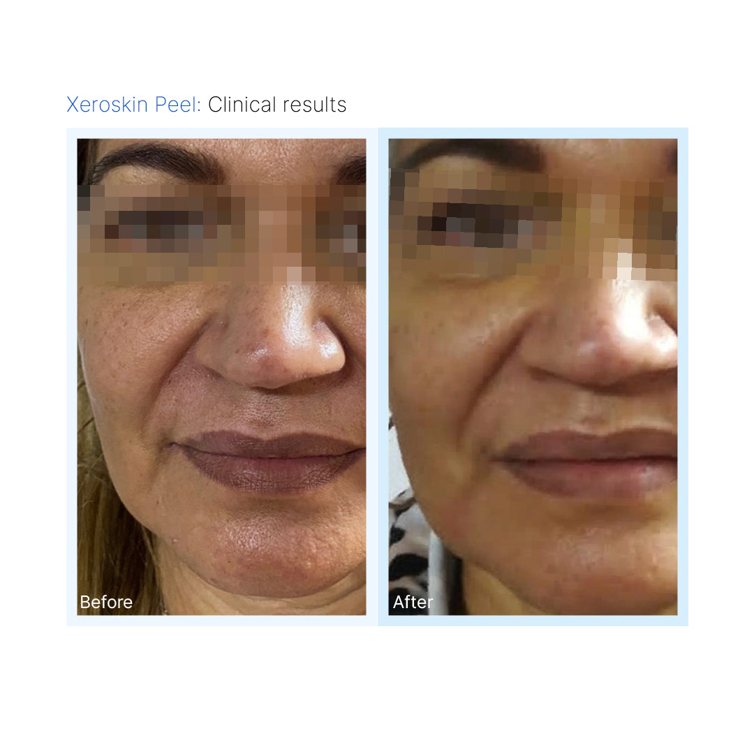 Xeroskin Peel