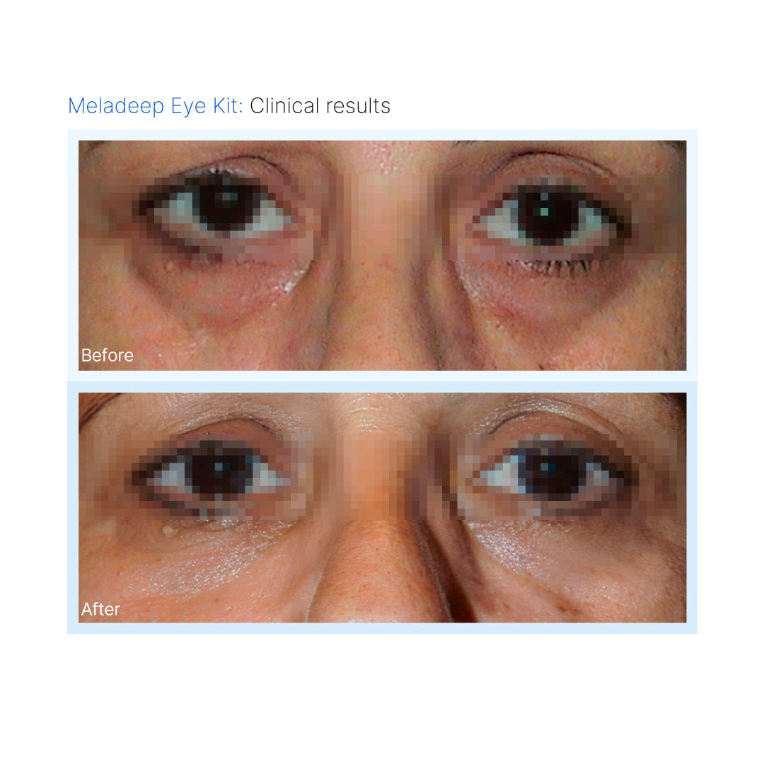 Eye Kit