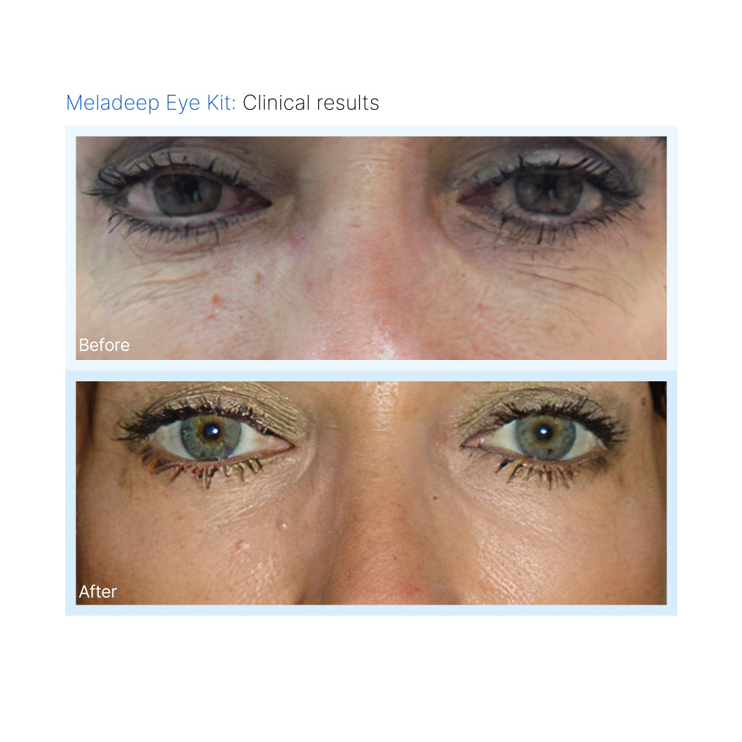 Eye Kit