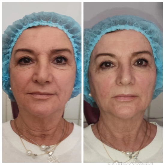 before and after DNA PEPT-HA