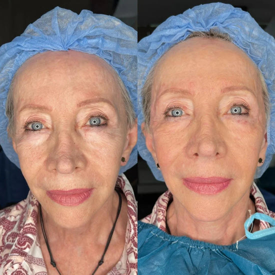 before and after TIGF