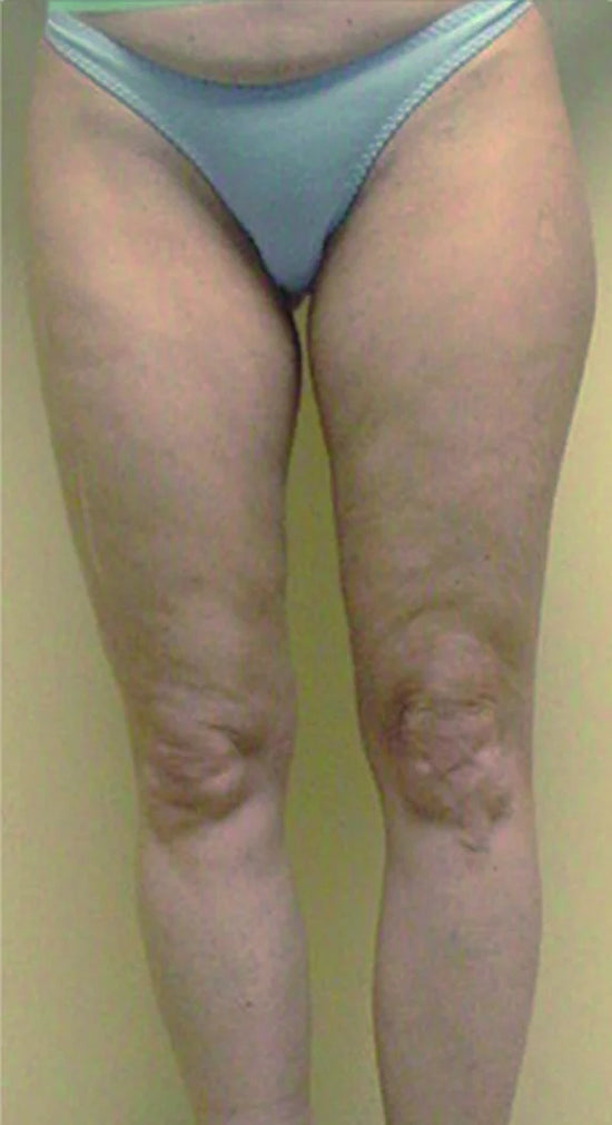 before and after Slimming