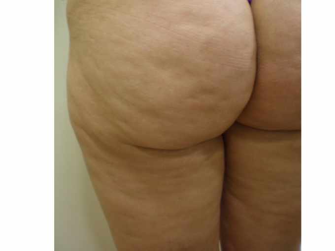 Antes